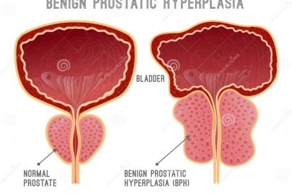 Recensioni Adenoma Prostata Opinioni e Testimonianze