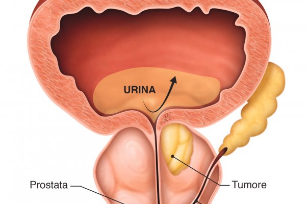 Malattie dell'adenoma prostatico sintomi e trattamenti