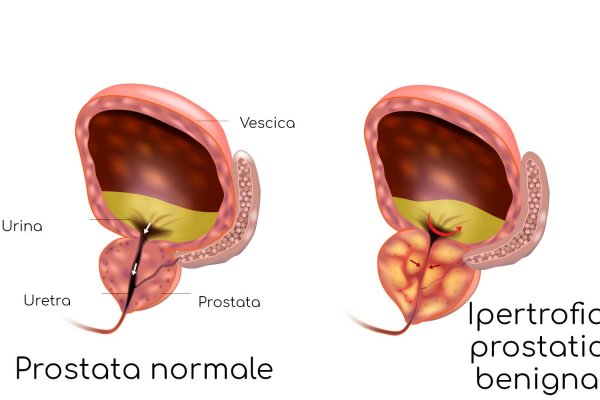 Ferro elevato nella prostata come influisce sulla salute maschile