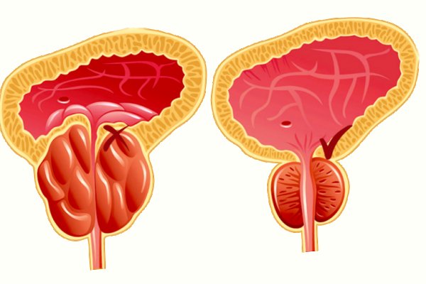 Trattamento dopo la prostatite Guida completa alla guarigione e recupero